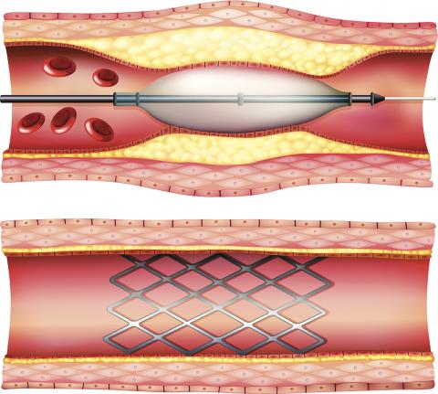 Surgical Procedures and Surgical Treatments for PAD