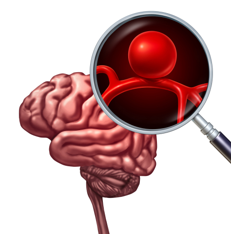 Aneurysm graphic